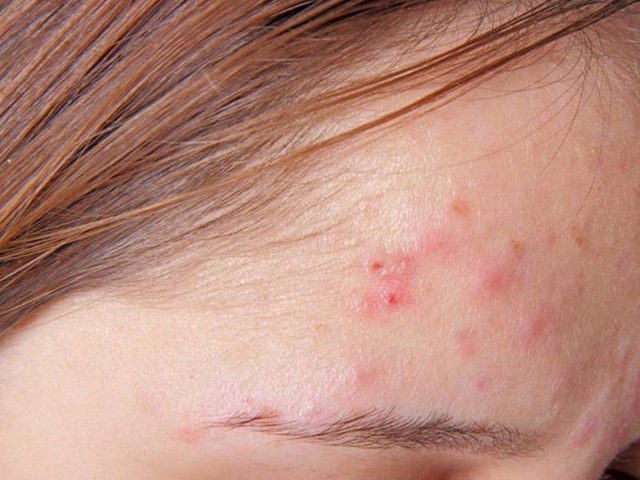 Tác hại của việc không dùng kem chống nắng - Ảnh 3. Tác hại của việc không dùng kem chống nắng - Ảnh 3.