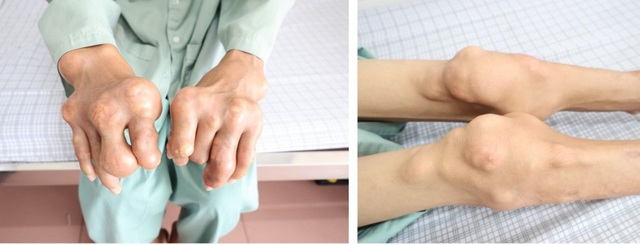 bien-chung-benh-gout-17600042453501763738758.jpg
