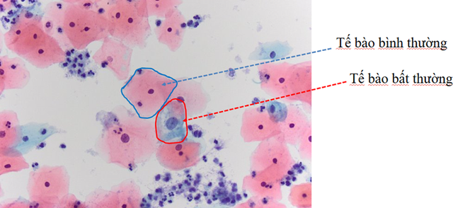 Đi khám xương khớp nghĩ bệnh tuổi trung niên, người phụ nữ 52 tuổi bất ngờ phát hiện tiền ung thư cổ tử cung - Ảnh 2. Đi khám xương khớp nghĩ bệnh tuổi trung niên, người phụ nữ 52 tuổi bất ngờ phát hiện tiền ung thư cổ tử cung - Ảnh 2.