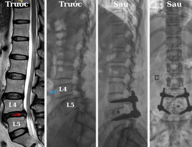 Thoái vị đĩa đệm cột sống lưng: Cần làm gì để hết đau? - Ảnh 1. Thoái vị đĩa đệm cột sống lưng: Cần làm gì để hết đau? - Ảnh 1.