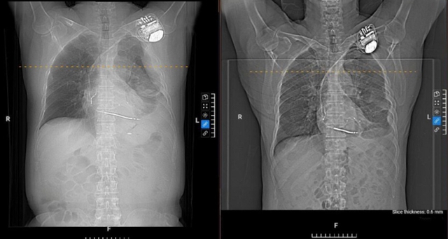 Đi khám vì đau ngực, người đàn ông 58 tuổi bất ngờ phát hiện tràn dịch màng phổi - Ảnh 1.