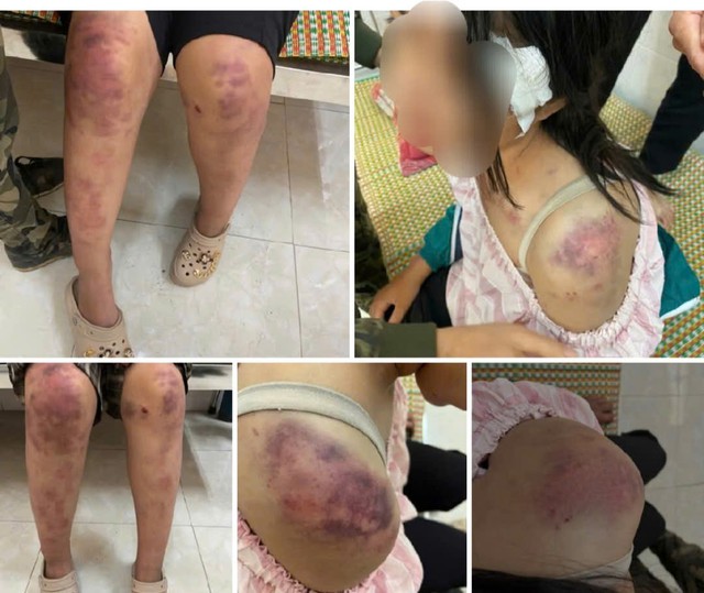 Hình ảnh cháu bé Thái Nguyên bị bầm tím khắp người gây phẫn nộ cộng đồng mạng - Ảnh 1.
