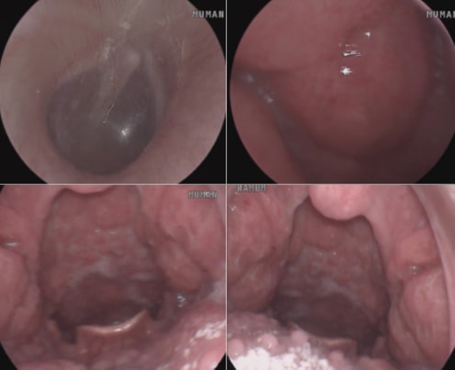 Thanh niên 22 tuổi ở Hà Nội đau họng kéo dài, đi khám mới thừa nhận một sai lầm trong chuyện 'thầm kín' - Ảnh 1.
