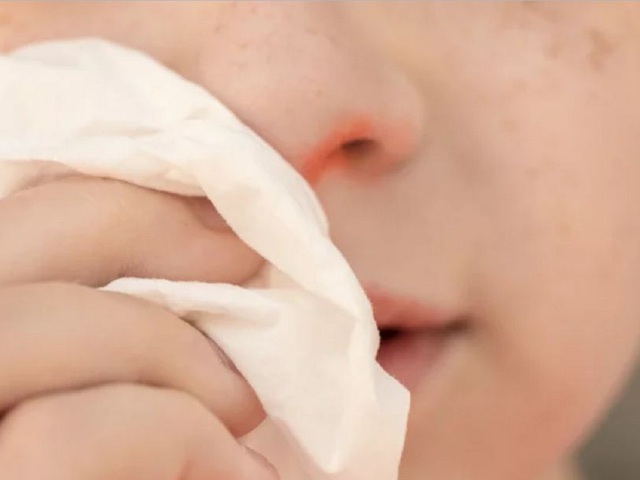 Khô mũi, chảy máu mũi trong ngày hanh khô: Cách chăm sóc và ngăn ngừa hiệu quả - Ảnh 1.
