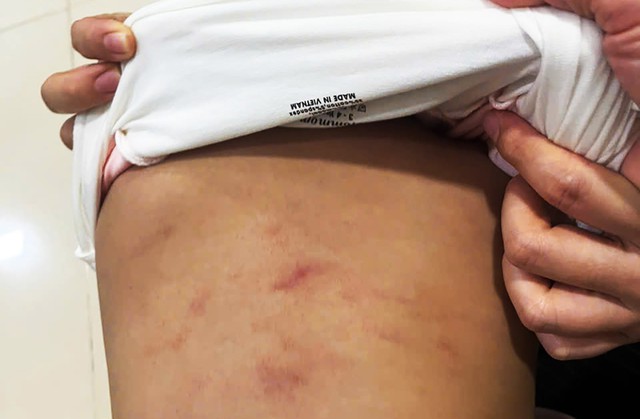 Tin sáng 7/11: Công an Lào Cai thông tin vụ nam sinh hành hung, đẩy bạn xuống hồ có dấu hiệu 'Giết người'; nối thành công 2 bàn tay bị đứt lìa sau ca phẫu thuật kéo dài 12 tiếng - Ảnh 2. Tin sáng 7/11: Công an Lào Cai thông tin vụ nam sinh hành hung, đẩy bạn xuống hồ có dấu hiệu 'Giết người'; nối thành công 2 bàn tay bị đứt lìa sau ca phẫu thuật kéo dài 12 tiếng - Ảnh 2.