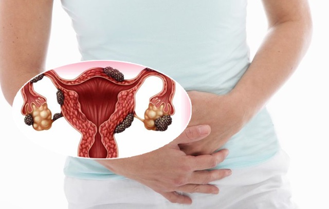 Lạc nội mạc tử cung: Chị em nên biết để phòng bệnh - Ảnh 2. Lạc nội mạc tử cung: Chị em nên biết để phòng bệnh - Ảnh 2.