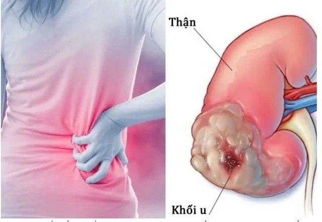 Người đàn ông 43 tuổi phát hiện ung thư thận, thừa nhận một sai lầm nhiều người Việt mắc phải - Ảnh 2.