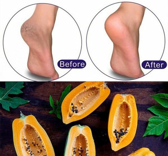 Cách khắc phục tình trạng da gót chân khô, nứt nẻ mùa đông - Ảnh 2. Cách khắc phục tình trạng da gót chân khô, nứt nẻ mùa đông - Ảnh 2.