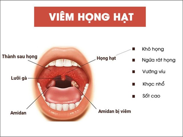 Các triệu chứng viêm họng hạt thường gặp và giải pháp cải thiện- Ảnh 1.