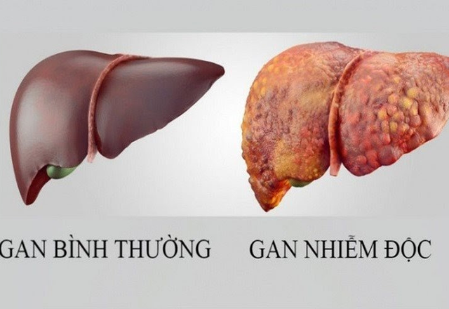Khi nào nên thải độc gan, đây là 3 nhóm người cần cảnh giác - Ảnh 2. Khi nào nên thải độc gan, đây là 3 nhóm người cần cảnh giác - Ảnh 2.
