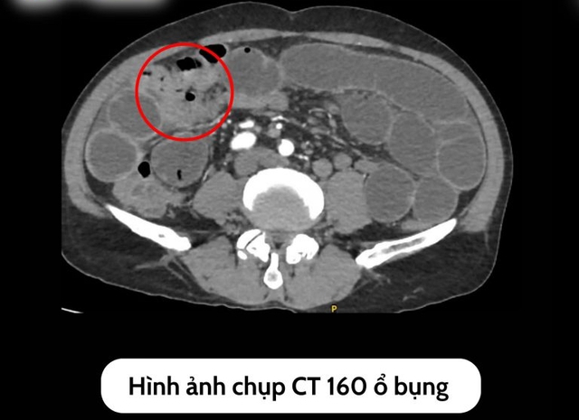 Người đàn ông 57 bất ngờ phát hiện bị tắc ruột từ dấu hiệu nhiều người Việt bỏ qua - Ảnh 2. Người đàn ông 57 bất ngờ phát hiện bị tắc ruột từ dấu hiệu nhiều người Việt bỏ qua - Ảnh 2.