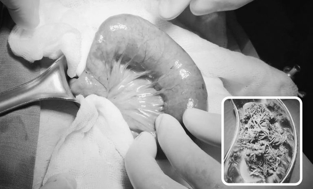Người đàn ông 57 bất ngờ phát hiện bị tắc ruột từ dấu hiệu nhiều người Việt bỏ qua - Ảnh 3. Người đàn ông 57 bất ngờ phát hiện bị tắc ruột từ dấu hiệu nhiều người Việt bỏ qua - Ảnh 3.