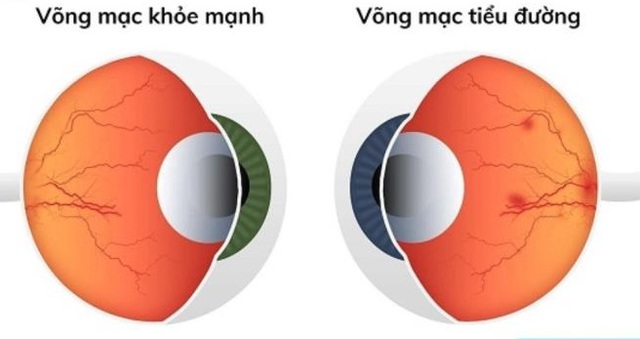 vong-mac-benh-tieu-duong6-174712304769836792490.jpg