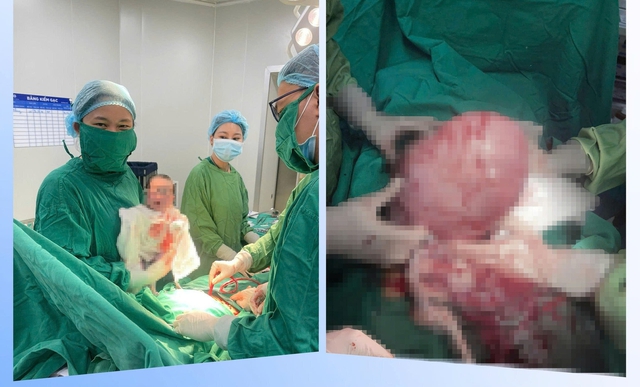 Người phụ nữ 30 tuổi vừa mang thai vừa có khối u xơ tử cung 'khủng' trong bụng - Ảnh 1. Người phụ nữ 30 tuổi vừa mang thai vừa có khối u xơ tử cung 'khủng' trong bụng - Ảnh 1.