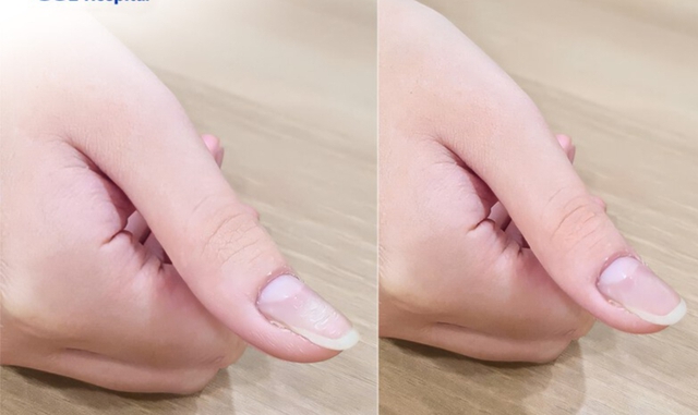 Đau ở ngón tay, bé 13 tuổi bất ngờ phát hiện bị u cuộn mạch, bác sĩ chỉ rõ có dấu hiệu này cần khám sớm - Ảnh 2.