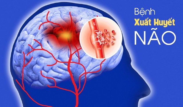 dot-quy-xuat-huyet-nao-17466793942201571991318.jpg