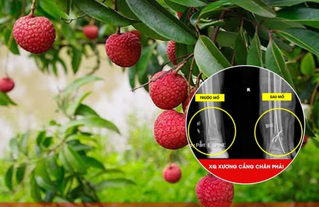 Người đàn ông 51 tuổi ở Phú Thọ nhập viện gấp sau khi trèo cây hái vải - Ảnh 2.