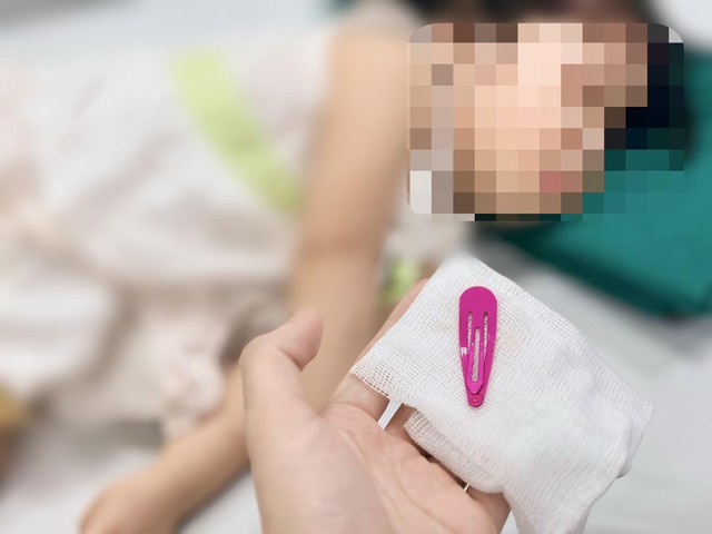 Bé gái 21 tháng tuổi nhập viện gấp với chiếc kẹp tóc trong dạ dày- Ảnh 2. Bé gái 21 tháng tuổi nhập viện gấp với chiếc kẹp tóc trong dạ dày- Ảnh 2.