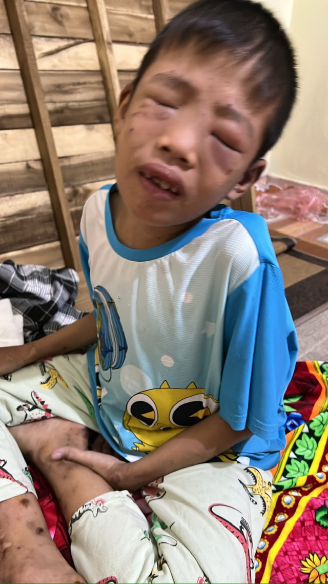 MS 1012: Con lớn bị tâm thần, người cha nghèo giờ cầu cứu điều trị cho con trai mắc bệnh hiếm gặp - Ảnh 2. MS 1012: Con lớn bị tâm thần, người cha nghèo giờ cầu cứu điều trị cho con trai mắc bệnh hiếm gặp - Ảnh 2.