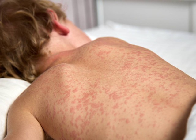 Cảnh giác với dấu hiệu bệnh sởi ở trẻ- Ảnh 2. Cảnh giác với dấu hiệu bệnh sởi ở trẻ- Ảnh 2.