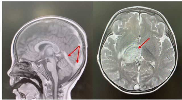 Bé 2,5 tuổi phát hiện bị đột quỵ từ dấu hiệu nhiều trẻ em Việt mắc phải- Ảnh 2. Bé 2,5 tuổi phát hiện bị đột quỵ từ dấu hiệu nhiều trẻ em Việt mắc phải- Ảnh 2.