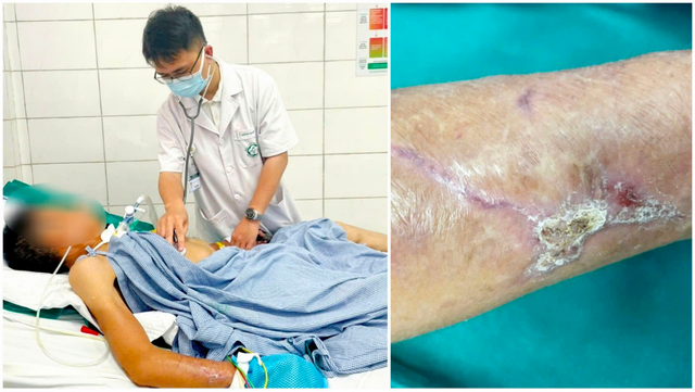 Người đàn ông 65 tuổi co giật, cứng hàm sau cú ngã đập tay vào thanh gỗ- Ảnh 1. Người đàn ông 65 tuổi co giật, cứng hàm sau cú ngã đập tay vào thanh gỗ- Ảnh 1.