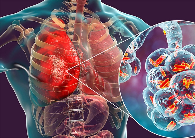 Bé 11 tuổi bất ngờ phát hiện ung thư phổi, nguyên nhân từ một sai lầm mà nhiều nam giới Việt mắc phải - Ảnh 2. Bé 11 tuổi bất ngờ phát hiện ung thư phổi, nguyên nhân từ một sai lầm mà nhiều nam giới Việt mắc phải - Ảnh 2.
