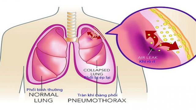 tran-khi-mang-phoi-5-175039363416812009320.jpg