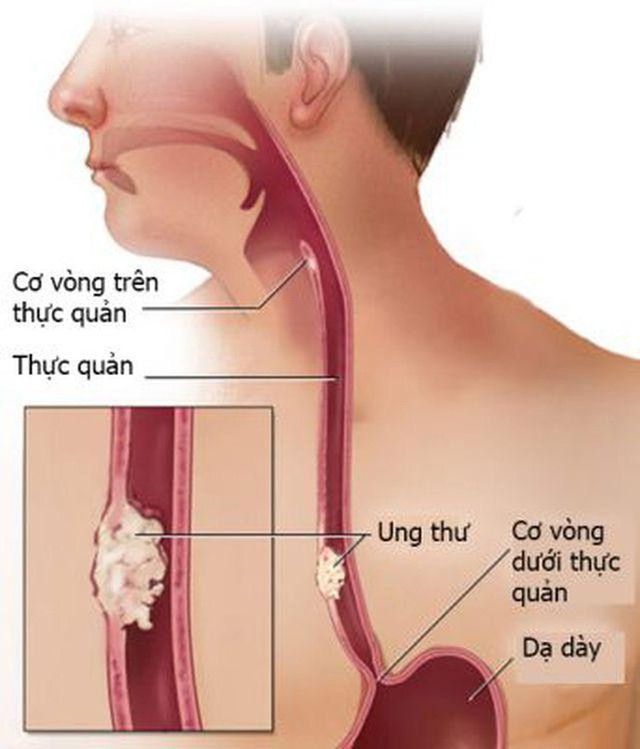 Người đàn ông 58 tuổi ở Quảng Ninh bị ung thư thực quản tái phát thừa nhận 1 sai lầm nhiều người Việt bỏ qua - Ảnh 2. Người đàn ông 58 tuổi ở Quảng Ninh bị ung thư thực quản tái phát thừa nhận 1 sai lầm nhiều người Việt bỏ qua - Ảnh 2.