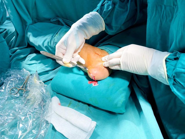 Cảnh giác với biến chứng nguy hiểm của bệnh gout- Ảnh 2. Cảnh giác với biến chứng nguy hiểm của bệnh gout- Ảnh 2.
