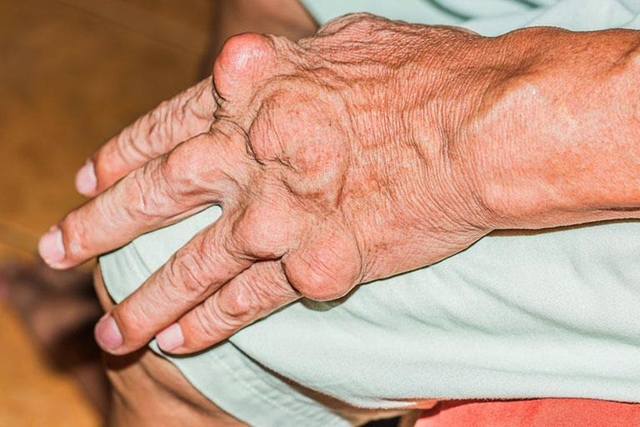Cảnh giác với biến chứng nguy hiểm của bệnh gout- Ảnh 3. Cảnh giác với biến chứng nguy hiểm của bệnh gout- Ảnh 3.