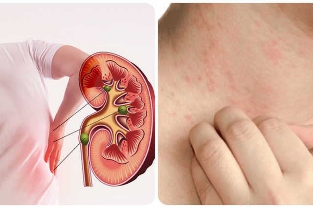 7 việc nên làm để phòng nguy cơ suy thận - Ảnh 2. 7 việc nên làm để phòng nguy cơ suy thận - Ảnh 2.