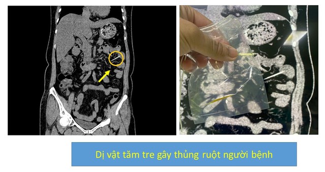 Liên tiếp 2 người ở Phú Thọ bị thủng đường tiêu hóa, bác sĩ cảnh báo thói quen nguy hiểm nhiều người mắc phải- Ảnh 2.