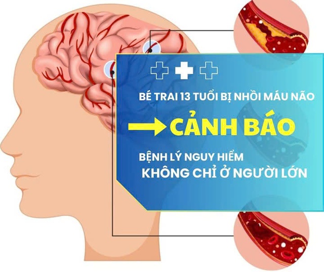 Trước khi nhập viện vì nhồi máu não, bé 13 tuổi ở Quảng Ninh có biểu hiện nguy hiểm này- Ảnh 2. Trước khi nhập viện vì nhồi máu não, bé 13 tuổi ở Quảng Ninh có biểu hiện nguy hiểm này- Ảnh 2.