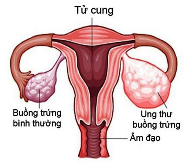 Người phụ nữ 63 tuổi bị ung thư buồng trứng di căn từ dấu hiệu nhiều chị em Việt bỏ qua- Ảnh 3. Người phụ nữ 63 tuổi bị ung thư buồng trứng di căn từ dấu hiệu nhiều chị em Việt bỏ qua- Ảnh 3.