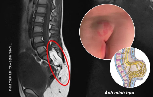 Bé 10 tuổi ở Phú Thọ bị dị tật tủy sống từ dấu hiệu nhiều người Việt bỏ qua - Ảnh 2.