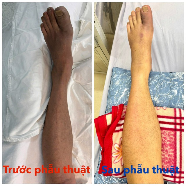 Người đàn ông 58 tuổi ở Bắc Ninh nửa đêm nhập viện vì tắc động mạch thừa nhận có tiền sử mắc 2 bệnh nguy hiểm - Ảnh 2.