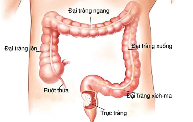Người đàn ông 66 tuổi ở Ninh Bình mắc cùng lúc 2 bệnh ung thư tiêu hóa từ dấu hiệu nhiều người Việt bỏ qua- Ảnh 2. Người đàn ông 66 tuổi ở Ninh Bình mắc cùng lúc 2 bệnh ung thư tiêu hóa từ dấu hiệu nhiều người Việt bỏ qua- Ảnh 2.