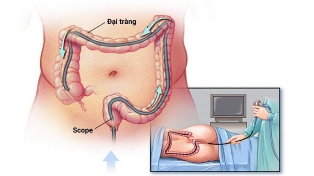 Người đàn ông ung thư đại tràng giai đoạn 4 ân hận vì không làm việc này dù đã được cảnh cáo trước - Ảnh 3. Người đàn ông ung thư đại tràng giai đoạn 4 ân hận vì không làm việc này dù đã được cảnh cáo trước - Ảnh 3.
