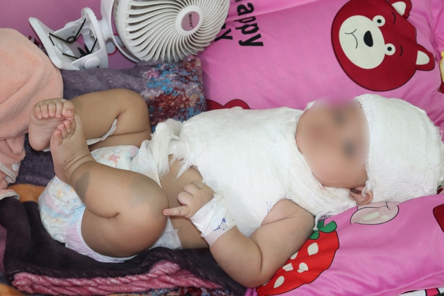 Phẫu thuật phục hồi đám rối thần cánh tay cho bé 5 tháng tuổi do chấn thương sản khoa- Ảnh 2.