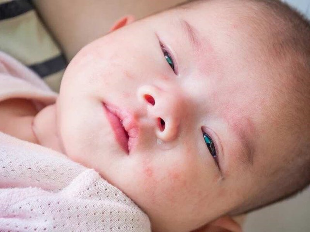 Làm gì khi trẻ bị viêm da? - Ảnh 4. Làm gì khi trẻ bị viêm da? - Ảnh 4.