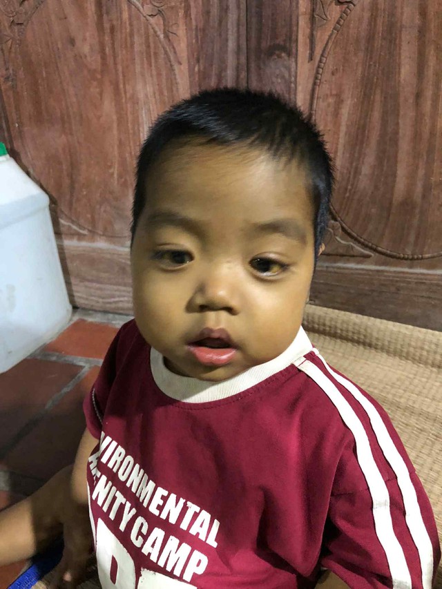 MS 1018: Sự sống mong manh của bé trai 21 tháng tuổi bị teo mật bẩm sinh, xơ gan - Ảnh 2. MS 1018: Sự sống mong manh của bé trai 21 tháng tuổi bị teo mật bẩm sinh, xơ gan - Ảnh 2.