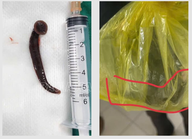 Người đàn ông bị đỉa chui vào niệu đạo trong lúc làm việc ngoài đồng - Ảnh 1. Người đàn ông bị đỉa chui vào niệu đạo trong lúc làm việc ngoài đồng - Ảnh 1.