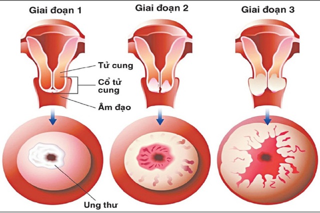 ung-thu-co-tu-cung-giai-doan-dau-1754906002431936729304.jpg