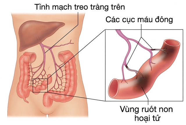 benh-tac-tinh-mach-1754990502866249536650.jpg