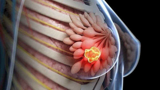 Không chỉ do di truyền: Ung thư vú đang gia tăng vì 5 thói quen này, bạn đã biết chưa? - Ảnh 1. Ung thư vú 2025: Xu hướng mới, phòng ngừa sớm và cách tầm soát hiệu quả - Ảnh 1.
