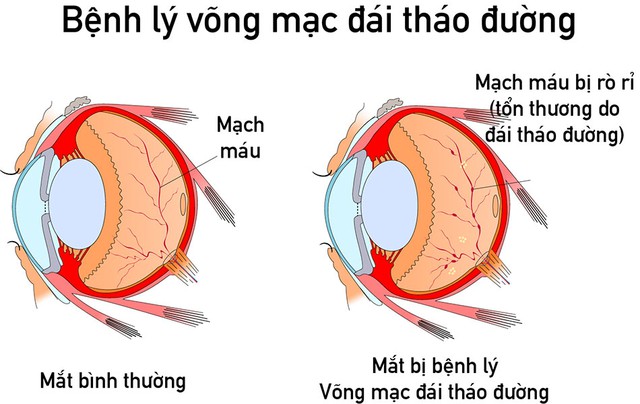 Nam thanh niên nguy cơ mù vĩnh viễn do sai lầm khi điều trị đái tháo đường nhiều người hay mắc phải - Ảnh 1. Nam thanh niên nguy cơ mù vĩnh viễn do sai lầm khi điều trị đái tháo đường nhiều người hay mắc phải - Ảnh 1.