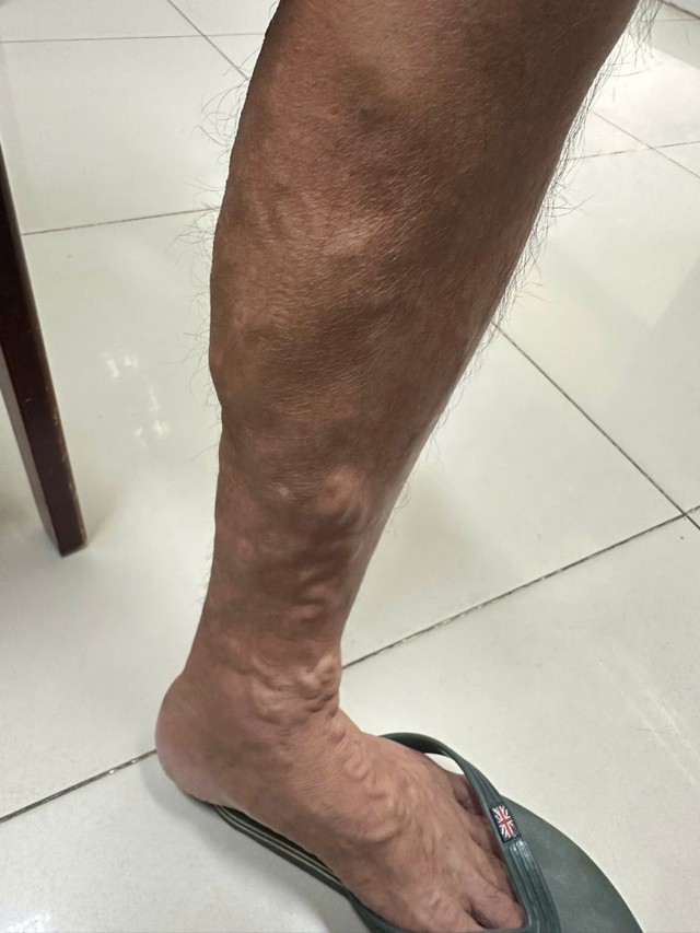 suy-gian-tinh-mach-1756484650430841294362.jpg