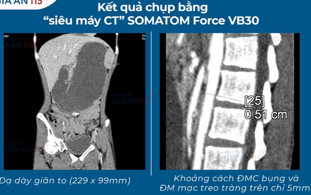 Ăn đủ mà vẫn đói: Nam thanh niên 27 tuổi đi khám phát hiện hội chứng hiếm gặp - Ảnh 2. Ăn đủ mà vẫn đói: Nam thanh niên 27 tuổi đi khám phát hiện hội chứng hiếm gặp - Ảnh 2.