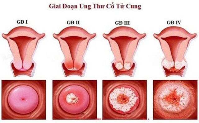 Người phụ nữ 35 tuổi 'thoát' ung thư cổ tử cung nhờ thói quen làm một việc quan trọng này  - Ảnh 2.